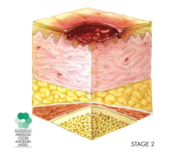 illustration of cross-section of a stage 2 pressure sore