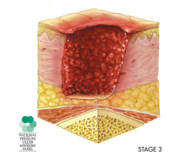 illustration of cross-section of a stage 3 pressure sore