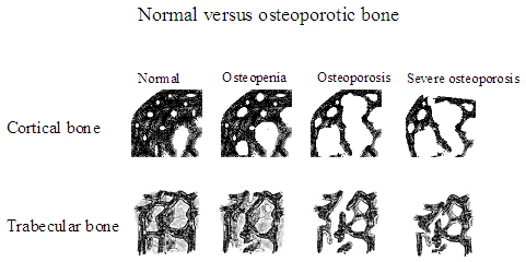 trabecular bone osteoporosis