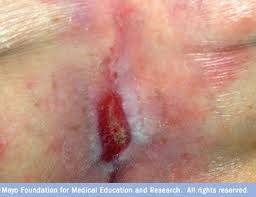 stage 2 ulcer