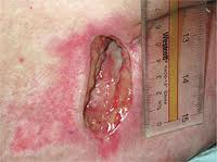 Stage 3 pressure ulcer - pale complexion.