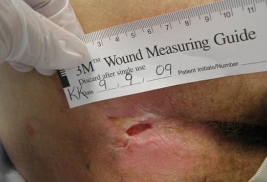Wound care: Measure and monitor.
