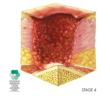 illustration of cross-section of a stage 4 pressure sore