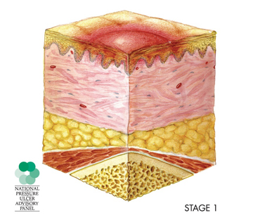 illustration of cross-section of a stage 1 pressure sore