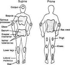 Ischial Pressure Ulcer Icd 9