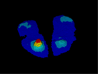 Figure 4: The three-dimensional display option provides further information about high-pressure areas of the buttocks. This case shows asymmetrical pressure, with high pressure on one side and low pressure on the other.