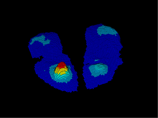 Pressure Mapping Assessment for Wheelchair Users