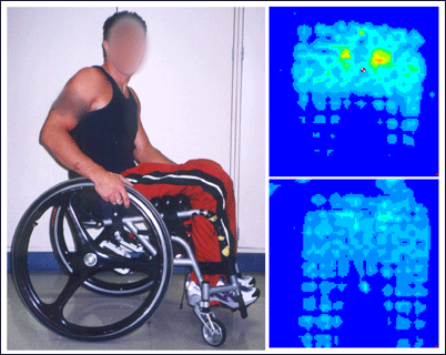 Figure 6: Pressure maps show pressure before (top) and after (bottom) adding a wedge to the patient's seating, improving distribution of pressure.