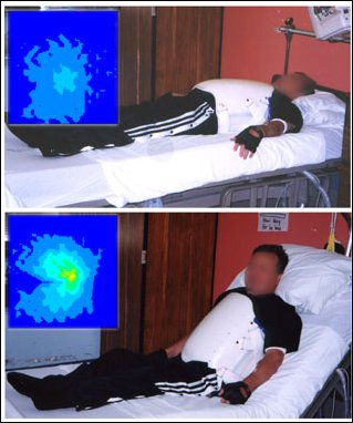 Figure 8: Pressure map while lying flat in bed is good (top) but gets worse when back rest is elevated.