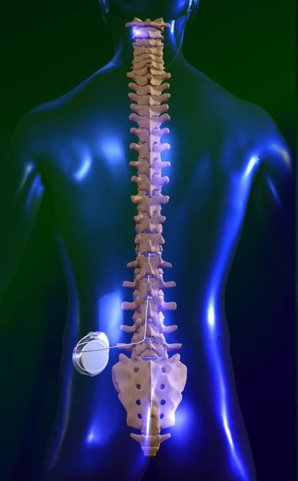 Image showing placement of pump and catheter into spine