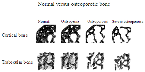 Images showing changes in bone from normal density to the more porous bone of severe osteoporosis.