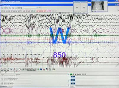 Polysomnograph report.