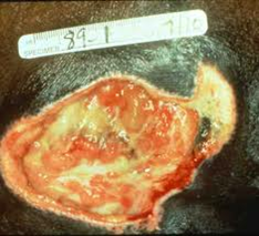 ulcer ulcers spinal