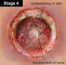 Stage 4 pressure ulcer - pale complexion.